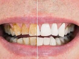 टूथपेस्ट से दांत रगड़ने की बजाए इस चीज से करें दांतों की सफाई, 7 दिन में दिखने लगेगी दूध जैसी चमक