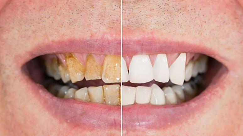 टूथपेस्ट से दांत रगड़ने की बजाए इस चीज से करें दांतों की सफाई, 7 दिन में दिखने लगेगी दूध जैसी चमक