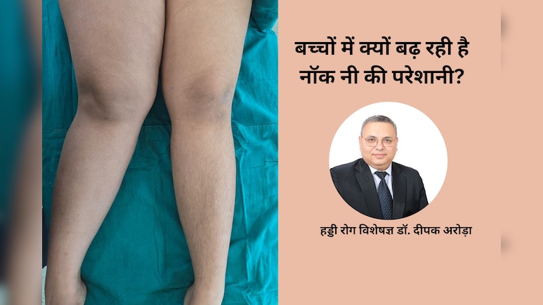 बच्चों में क्यों बढ़ रही 'नॉक नी' की समस्या, Orthopedic Surgeon से जानिए  लक्षण, कारण और इलाज