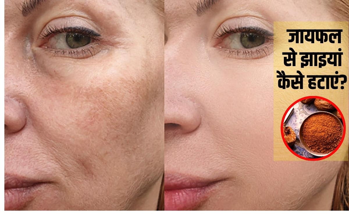 जायफल से झाइयां कैसे हटाएं? झाइयों के लिए जायफल कैसे लगाएं, यह रहा वह रामबाण तरीका