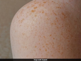 Bangladesh Measles Outbreak Claims 4 More Lives; Deaths Rise To 605