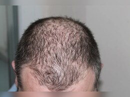 गंजेपन से निजात के लिए भूलकर भी न करें ये काम, वरना बढ़ सकता है आत्महत्या का खतरा