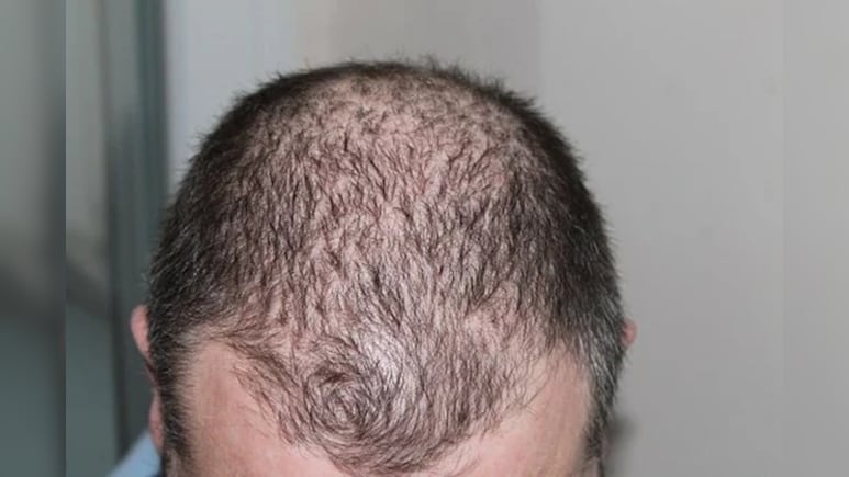 गंजेपन से निजात के लिए भूलकर भी न करें ये काम, वरना बढ़ सकता है आत्महत्या का खतरा