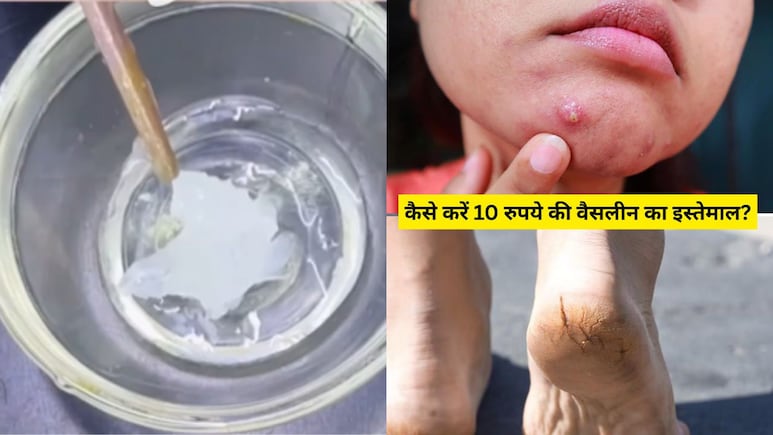 इन 5 तरीकों से करें 10 रुपये की वैसलीन का इस्तेमाल, पिंपल्स होंगे दूर, मुलायम हो जाएंगी एड़ियां