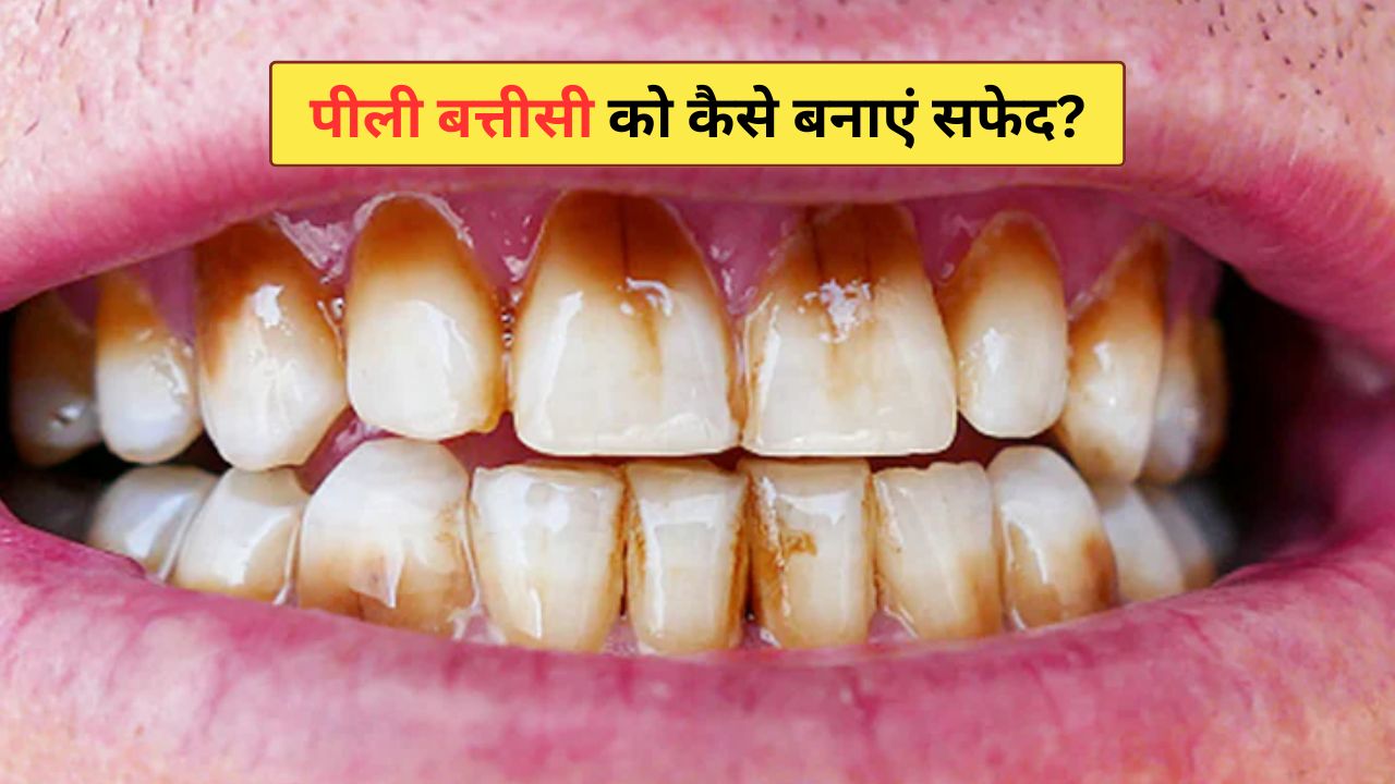 दांत क्यों हो जाते हैं पीले? दांतों के अंदर पीलापन कैसे साफ करें, डॉक्टर ने बताए सबसे आसान 4 घरेलू नुस्खे