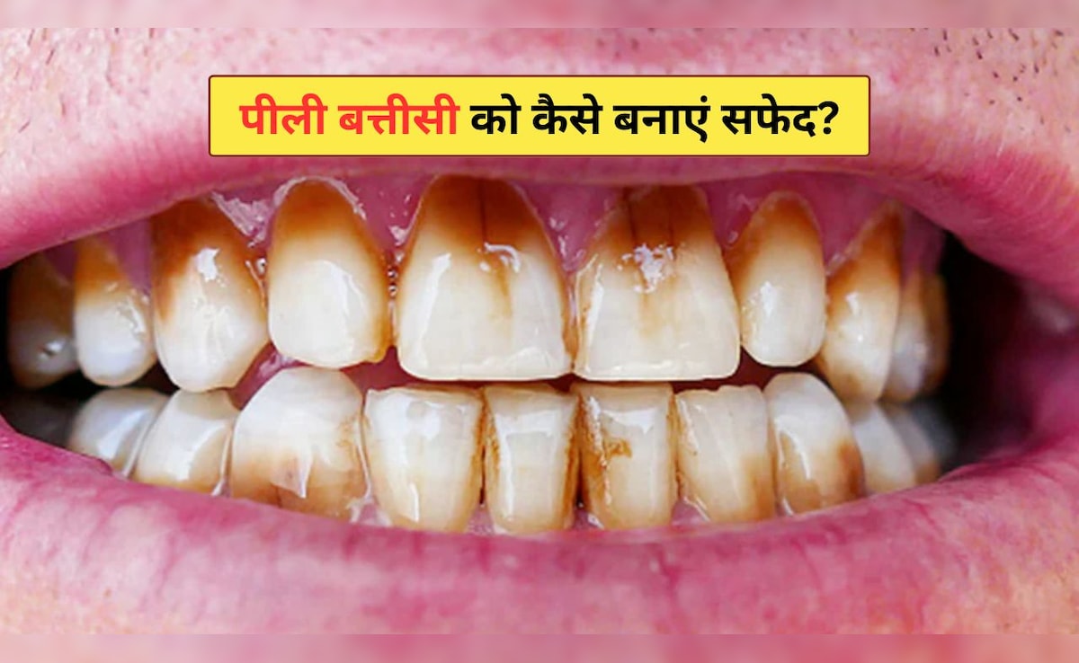 दांत क्यों हो जाते हैं पीले? दांतों के अंदर पीलापन कैसे साफ करें, डॉक्टर ने बताए सबसे आसान 4 घरेलू नुस्खे