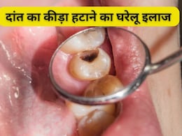 Gharelu Nuskhe: दांतों में कीड़ा लग जाए तो क्या करें? डॉक्टर से जानें घरेलू इलाज