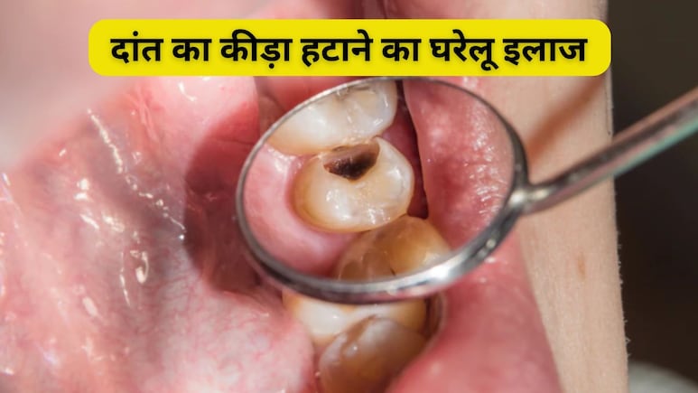 Gharelu Nuskhe: दांतों में कीड़ा लग जाए तो क्या करें? डॉक्टर से जानें घरेलू इलाज