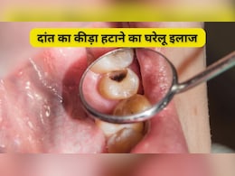 मिल गया दांत के कीड़े का घरेलू इलाज, कैविटी से छुटकारा पाने का रामबाण है ये घरेलू नुस्खा