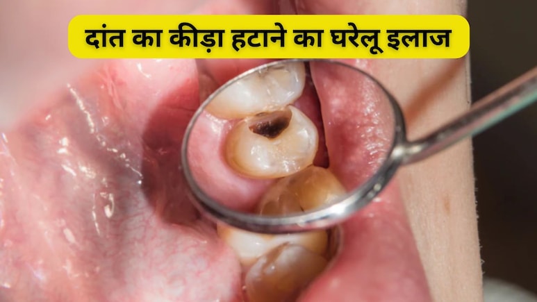 मिल गया दांत के कीड़े का घरेलू इलाज, कैविटी से छुटकारा पाने का रामबाण है ये घरेलू नुस्खा