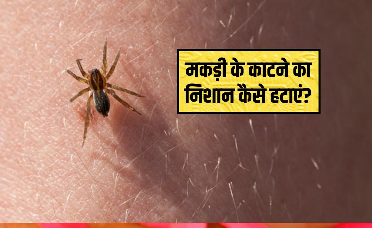 मकड़ी के काटने के कितने समय बाद लक्षण दिखाई देते हैं? मकड़ी काटने पर क्या लगाना चाहिए, मकड़ी के काटने का निशान कैसे हटाएं