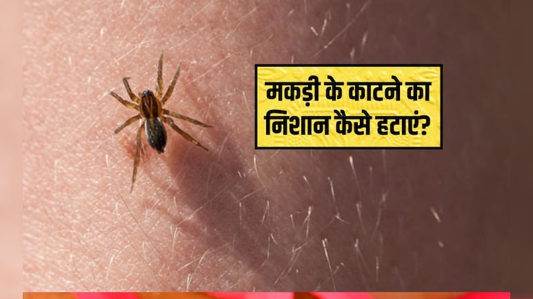 मकड़ी के काटने के कितने समय बाद लक्षण दिखाई देते हैं? मकड़ी काटने पर क्या लगाना चाहिए, मकड़ी के काटने का निशान कैसे हटाएं