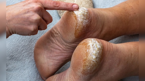 Cracked Heels: थंडीत भेगा पडलेल्या टाचांमुळे खूप त्रास होतो का, कोणत्या व्हिटॅमिनच्या कमतरतेमुळे टाचांना भेगा?