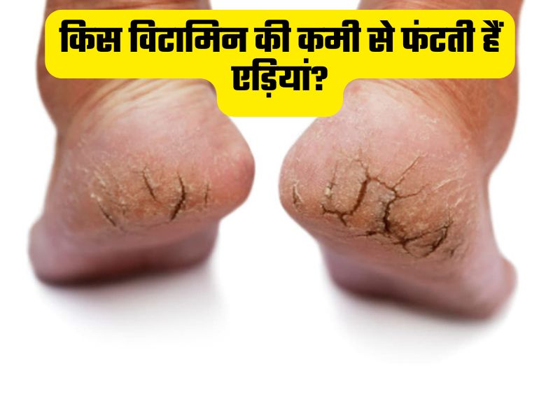 ठंड नहीं इस विटामिन की कमी से फटती हैं एड़ियां, जानिए कैसे बनाएं इनको चिकना और मुलायम