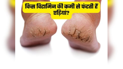 ठंड नहीं इस विटामिन की कमी से फटती हैं एड़ियां, जानिए कैसे बनाएं इनको चिकना और मुलायम