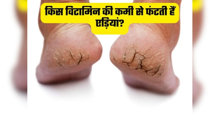 ठंड नहीं इस विटामिन की कमी से फटती हैं एड़ियां, जानिए कैसे बनाएं इनको चिकना और मुलायम