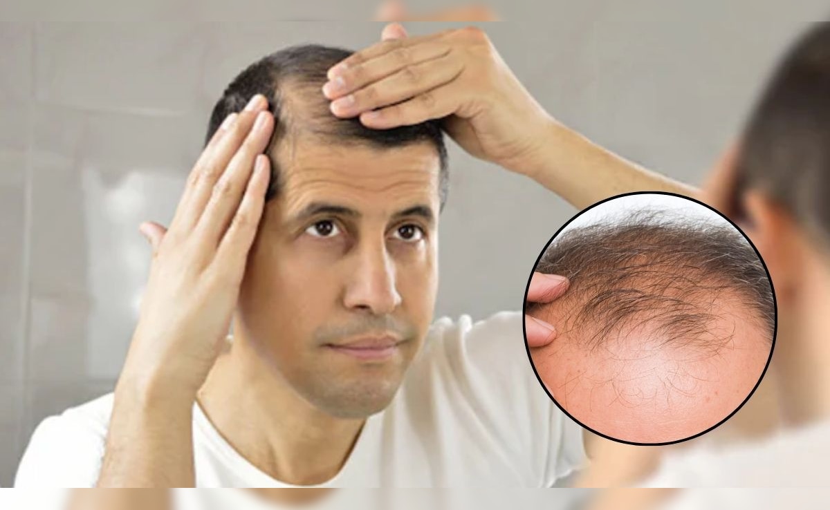 इस सीरम से 20 दिनों में उगने लगेंगे बाल, ताइवान यूनिवर्सिटी के वैज्ञानिकों ने किया कमाल, गंजे सिर पर भी दिखेंगे हेयर