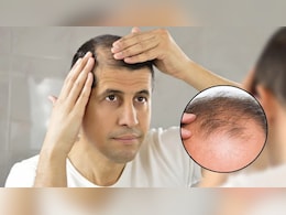 इस सीरम से 20 दिनों में उगने लगेंगे बाल, ताइवान यूनिवर्सिटी के वैज्ञानिकों ने किया कमाल, गंजे सिर पर भी दिखेंगे हेयर