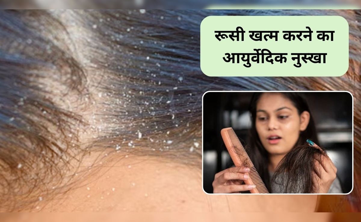 डैंड्रफ कैसे हटाए, dandruff ke gharelu upay, बाल से रूसी कैसे हटाए, how to remove dandruff permanently, natural remedies for dandruff, डैंड्रफ का रामबाण इलाज, दही से रूसी हटाने का तरीका, नीम से रूसी कैसे हटाए, dandruff treatment at home, सेब का सिरका रूसी के लिए, tea tree oil for dandruff, डैंड्रफ होने के कारण Latest and Breaking News on NDTV