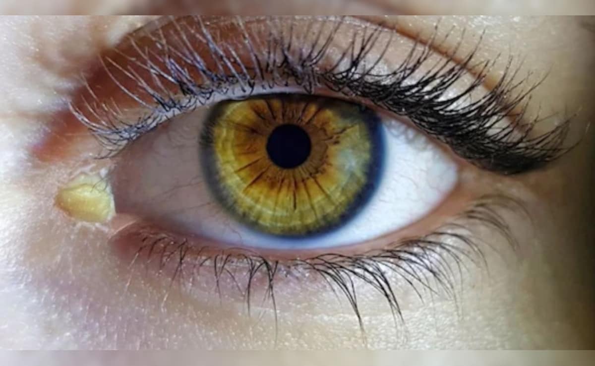 कौन से विटामिन की कमी से आंखों में ज्यादा कीचड़ आता है? डॉक्टर से जानें आंखों में सफेद कीचड़ क्यों आता है