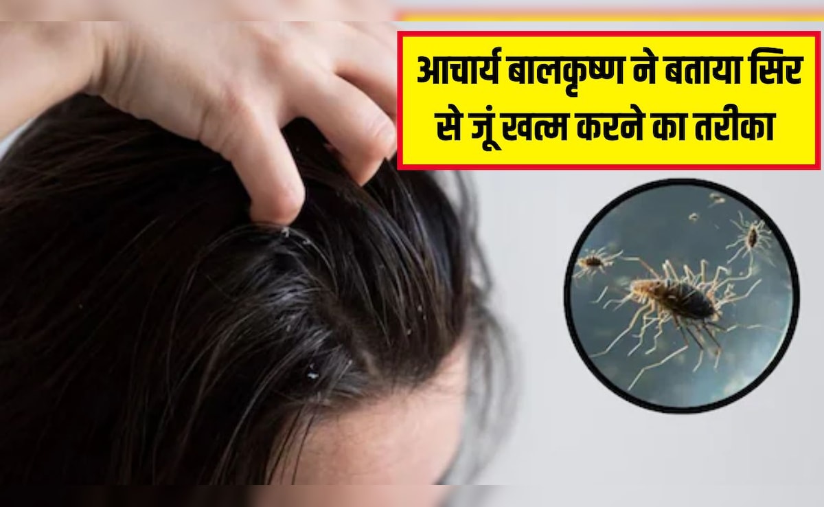 Acharya Balkrishna ने बताया सिर से जूं खत्म करने का असरदार नुस्खा, इसे लगाते ही हो जाएंगी ढेर
