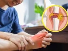 Uric Acid वाढले? डॉक्टरांनी सांगितले 3 नैसर्गिक उपाय, सर्व त्रासांपासून होईल सुटका