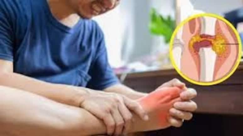 Uric Acid वाढले? डॉक्टरांनी सांगितले 3 नैसर्गिक उपाय, सर्व त्रासांपासून होईल सुटका