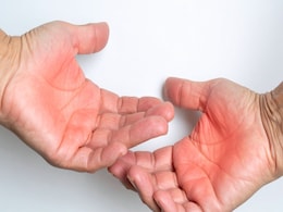 जलने से होने वाले जख्म पर क्या लगाएं? तुरंत राहत देंगे ये 4 घरेलू नुस्खे, त्वचा पर नहीं पड़ेगा दाग