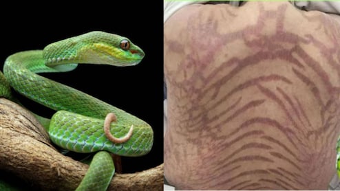 ये चीज लगाकर सो गई लड़की, सोकर उठी तो बन गई नागिन! पीठ की लकीरें देख मुंह से निकल गई चीखें