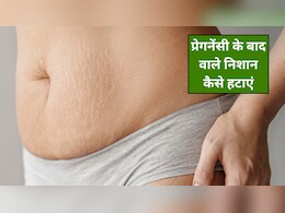 प्रेगनेंसी के बाद शरीर पर दिख रहे हैं स्ट्रेच मार्क्स? अपनाएं ये 4 घरेलू नुस्खे, हट जाएंगे निशान