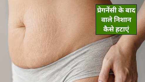 प्रेगनेंसी के बाद शरीर पर दिख रहे हैं स्ट्रेच मार्क्स? अपनाएं ये 4 घरेलू नुस्खे, हट जाएंगे निशान