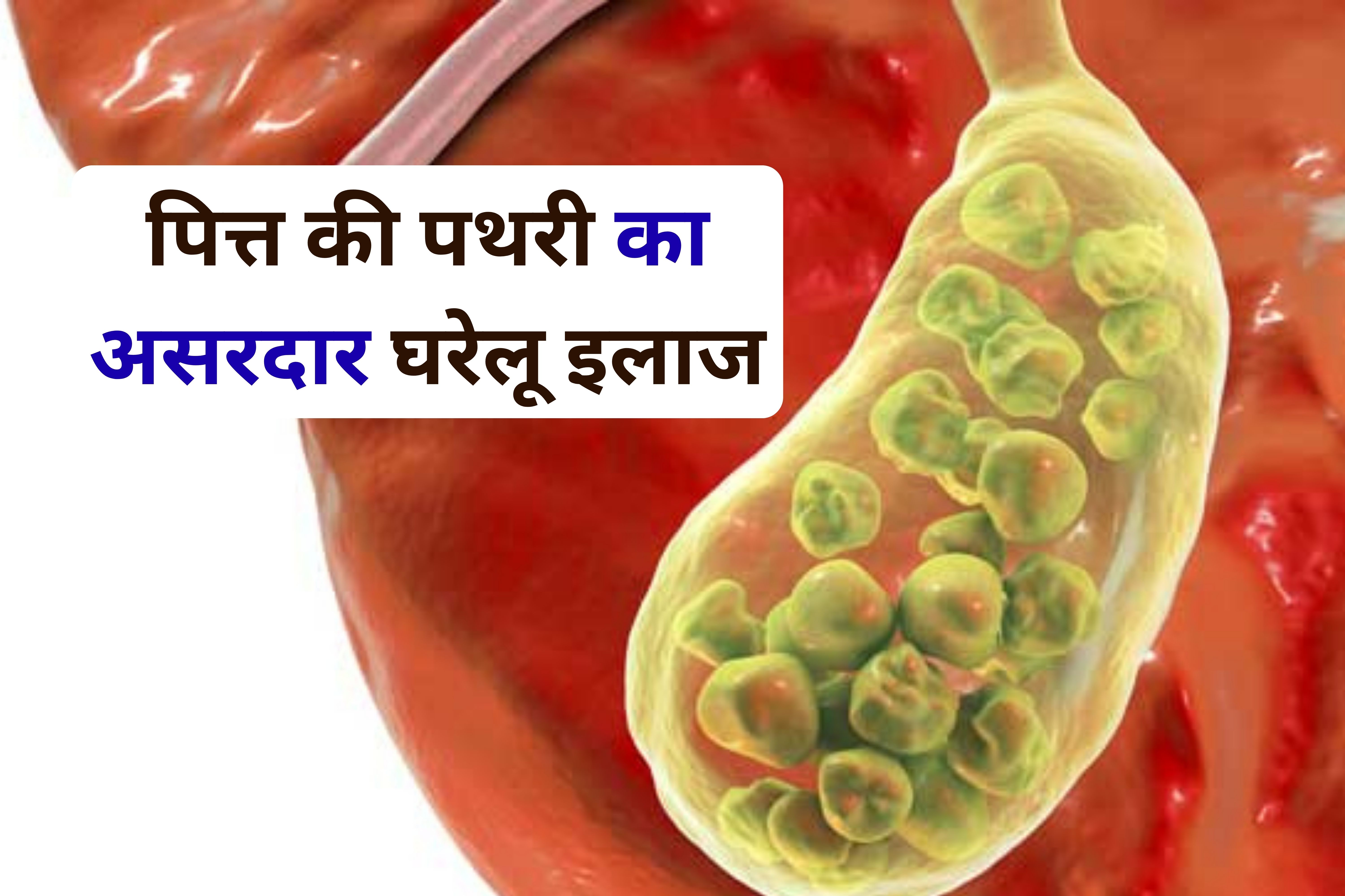 Gallstones cause :  आपकी ये 5 खराब आदतें बना रहीं हैं पित्त की पथरी! आयुर्वेदिक नुस्खों से पाएं तुरंत राहत