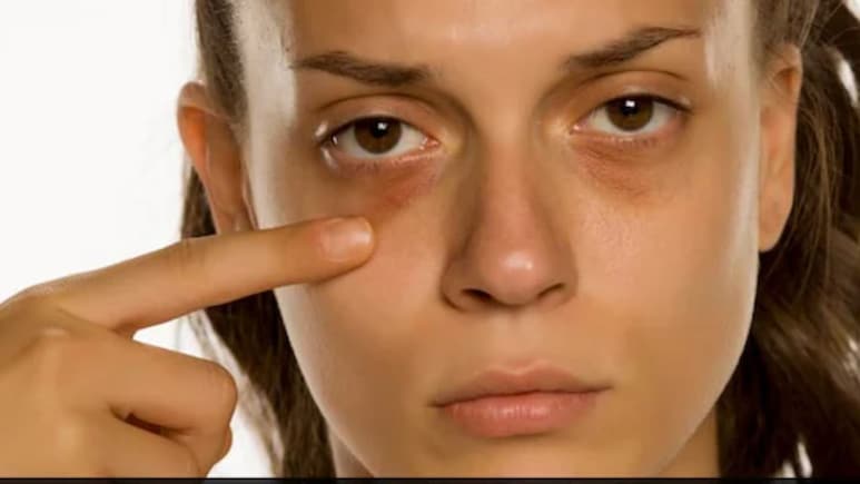 आंखों के नीचे से डार्क सर्कल्स साफ करने के लिए क्या करें? Korean Facial Expert ने बताया सबसे असरदार तरीका
