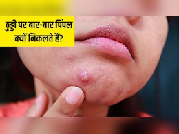 चिन पर पिंपल क्यों होता है? डॉक्टर ने बताया ठुड्डी पर बार-बार पिंपल निकले तो क्या करें
