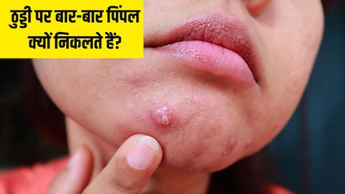 चिन पर पिंपल क्यों होता है? डॉक्टर ने बताया ठुड्डी पर बार-बार पिंपल निकले तो क्या करें