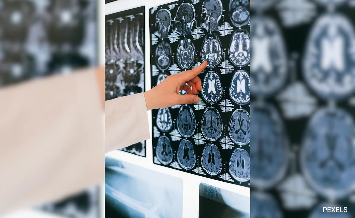 India's Chronic Kidney Disease Cases Hit 138 Million In 2023, 2nd Globally: Study