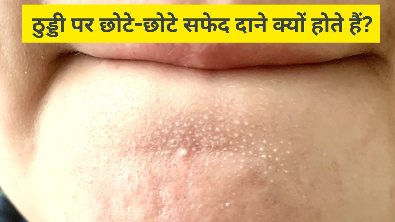 ठुड्डी पर छोटे-छोटे सफेद दाने क्यों होते हैं? स्किन के डॉक्टर से जानें इन्हें साफ करने के लिए क्या करें