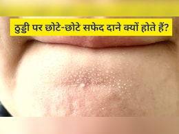 ठुड्डी पर छोटे-छोटे सफेद दाने क्यों होते हैं? स्किन के डॉक्टर से जानें इन्हें साफ करने के लिए क्या करें