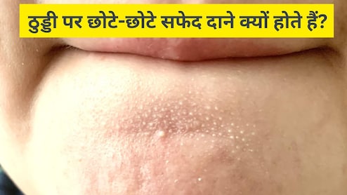 ठुड्डी पर छोटे-छोटे सफेद दाने क्यों होते हैं? स्किन के डॉक्टर से जानें इन्हें साफ करने के लिए क्या करें