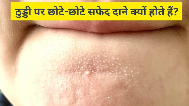 ठुड्डी पर छोटे-छोटे सफेद दाने क्यों होते हैं? स्किन के डॉक्टर से जानें इन्हें साफ करने के लिए क्या करें