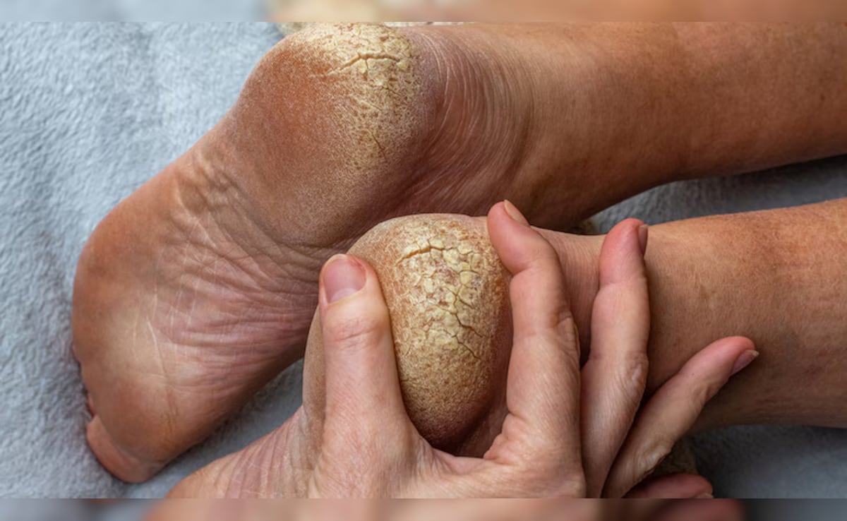 फटी एड़ियां