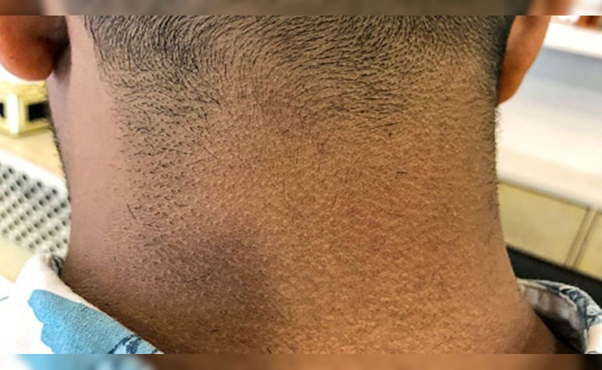 काली गर्दन के लिए घरेलू नुस्खा