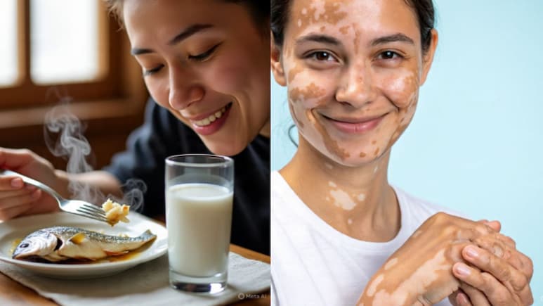 आज का सवाल: क्या सच में दूध और मछली साथ खाने से होता है स्किन पर सफेद दाग वाला रोग विटिलिगो?