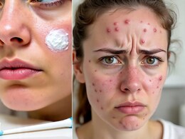 मुंहासों से छुटकारा कैसे पाएं? सर्दियों में मुंहासों का घरेलू इलाज हैं ये फेसपैक