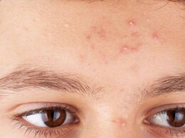 क्या सच में बासी लार लगाने से ठीक हो जाते हैं पिंपल्स? जानें क्या कहते हैं एक्सपर्ट