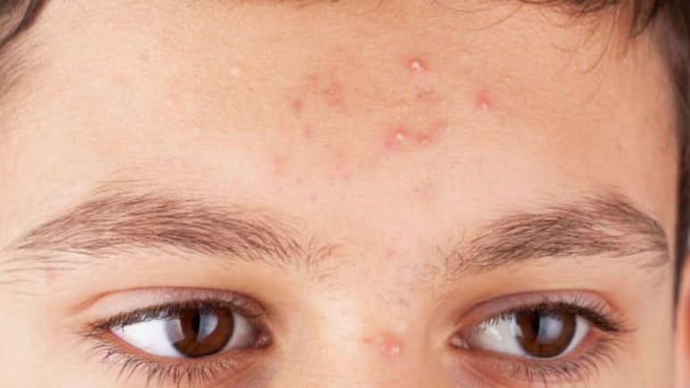 क्या सच में बासी लार लगाने से ठीक हो जाते हैं पिंपल्स? जानें क्या कहते हैं एक्सपर्ट