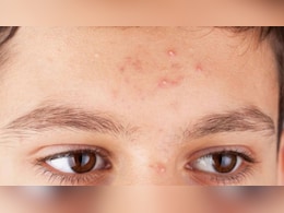 माथे की छोटी-छोटी फुंसियों से हो गए हैं परेशान? किचन में रखे इस पत्ते से बना लें दवाई, दाग-धब्बे भी होंगे दूर