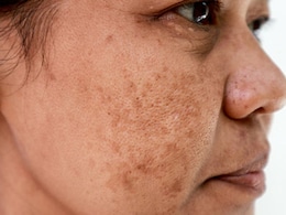 Nutritionist Explains Why Treating Pigmentation Needs More Than Skincare