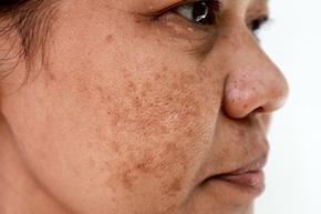 झाइयों के लिए सबसे अच्छा सीरम कौन सा है? डर्मेटोलॉजिस्ट से जान लें चेहरे पर झाइयां बढ़ जाएं तो क्या लगाएं