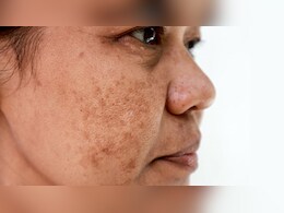 झाइयों के लिए सबसे अच्छा सीरम कौन सा है? डर्मेटोलॉजिस्ट से जान लें चेहरे पर झाइयां बढ़ जाएं तो क्या लगाएं